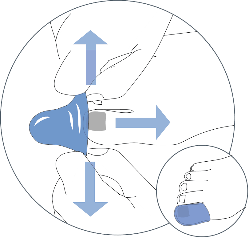 Covering toe with a NoWonder Toe Cover